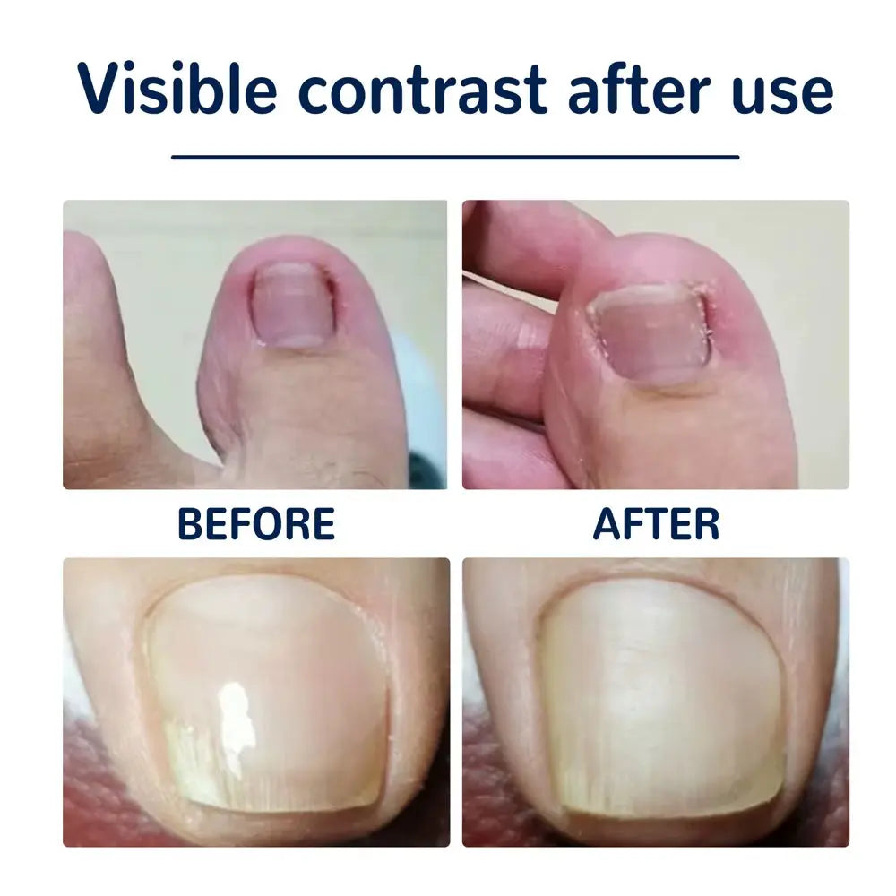 50Pcs Nail Correction Stickers Ingrown Toenail Corrector Patch Waterproof Paronychia Treatment Recover Corrector Pedicure Tool