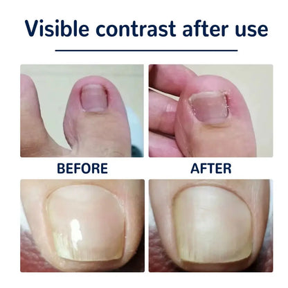 50Pcs Nail Correction Stickers Ingrown Toenail Corrector Patch Waterproof Paronychia Treatment Recover Corrector Pedicure Tool