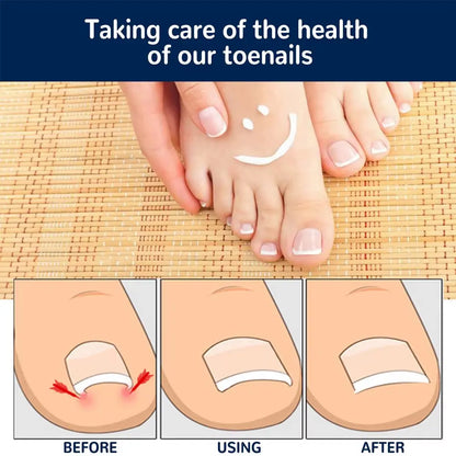 50Pcs Nail Correction Stickers Ingrown Toenail Corrector Patch Waterproof Paronychia Treatment Recover Corrector Pedicure Tool